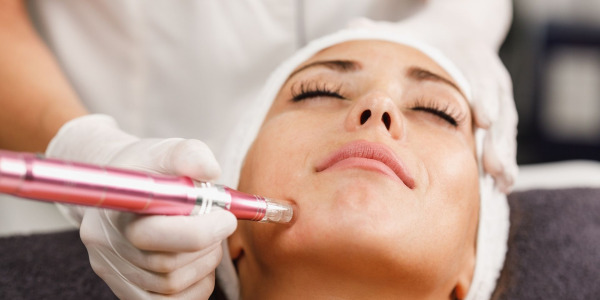 ¿Es Efectivo el Dermapen para las Cicatrices de Acné?